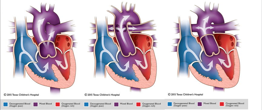 Truncus Arteriosus Pediatric Echocardiography